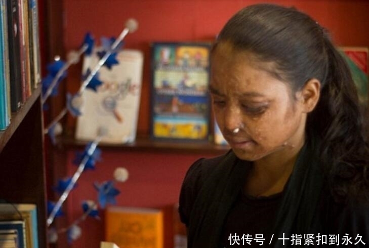 毁容|女孩17岁时因拒绝求婚，被32岁男子泼硫酸毁容