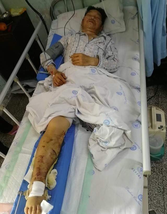  父亲|父亲只有1条腿，95后小伙为给爸安假肢，每天吃饭只花2块钱