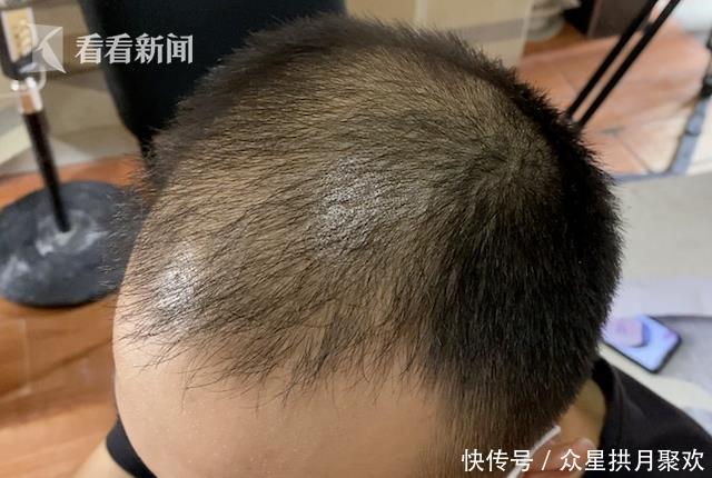 植发效果:从失败案例到成功逆袭