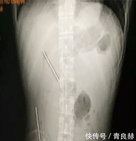  事前|不要脸不要命! 夫妻俩每做这事前, 都先吞枚钢钉...