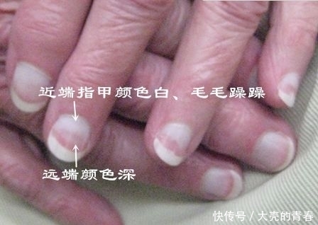  不好|肾不好，指甲知道？快对照着看看……