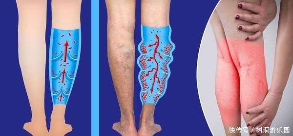  称为|这种蔬菜被称为“血栓斑块清道夫”，想血管畅通，日常不妨多吃点