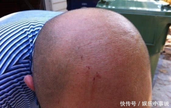  剧痛|男子出门上班，刚出门头顶传来剧痛，伸手一摸魂都飞了