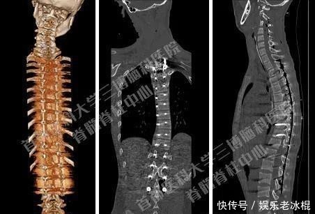 脊髓|非常罕见 15岁初中生莫名肢体无力 脊髓内竟然长满肿瘤