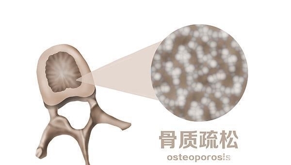  女性|为什么女性45岁后，容易得骨质疏松？吃什么能补钙？